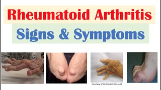 Rheumatoid arthritis Symptoms and treatments [upl. by Husein520]