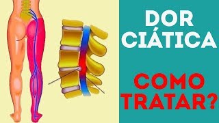 Dor Ciática Como tratar [upl. by Vashtee]