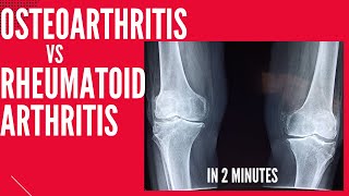 Gouty Arthritis in Foot and Ankle  Causes Symptoms amp Treatment [upl. by Elleraj968]