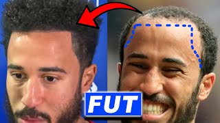 Andros Townsend FUT Hair Transplant Transformation [upl. by Akinot]