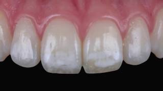 Tratamiento de la fluorosis mediante infiltración ICON [upl. by Esli618]