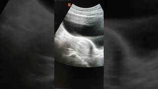 Bicornuate uterus with pregnancy [upl. by Sproul]