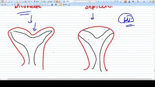 Difference between Bicornuate and Septate Uterus [upl. by Ayikat]