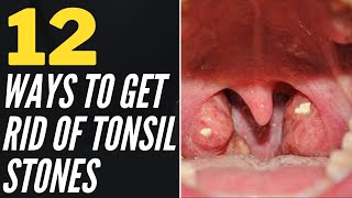 How to remove caseum from your tonsils [upl. by Ellord656]