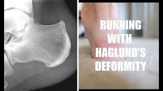 Running With Haglunds Deformity  The Galen Rupp Injury [upl. by Lemyt457]