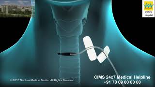 Thyroidectomy – CIMS Hospital [upl. by Vardon]