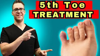 What To Do For A Broken Pinky Toe How To Tape amp Little Toe Treatment [upl. by Maze]