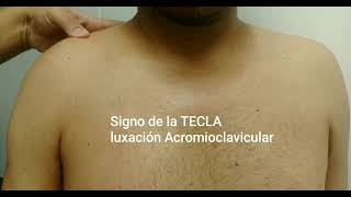 SIGNO DE LA TECLA LUXACIÓN ACROMIOCLAVICULAR [upl. by Weidner]