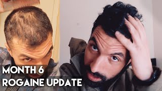 6 Month Rogaine Results Minoxidil [upl. by Ailaro514]