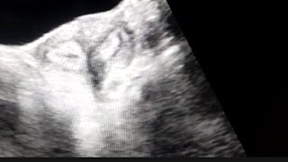 Bicornuate uterus on Ultrasound [upl. by Adnahcir]