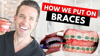 How Braces are Put On  Part IV Dr Nate [upl. by Lehacim]