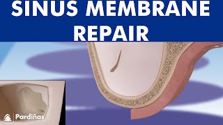 Sinus membrane perforation repair © [upl. by Arrec]