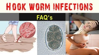 Hook worm Infections  FAQ and Answers [upl. by Kosaka]