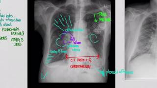 CXR Congestive Heart Failure CHF [upl. by Tjader]