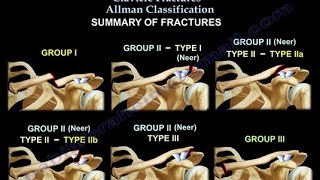 Clavicle Fractures Classification  Everything You Need To Know  Dr Nabil Ebraheim [upl. by Grissel824]