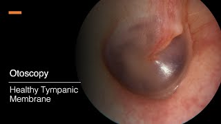 Tympanic Membrane Otosopy [upl. by Zednanref30]