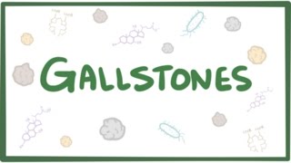 Gallstones cholelithiasis [upl. by Suirauqed]