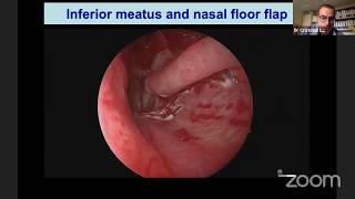 Septal Perforation Repair  How I Do It [upl. by Wooster]