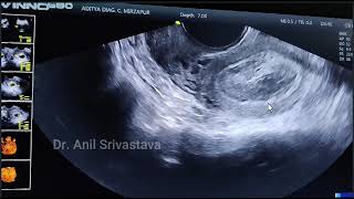 BICORNUATE BICOLLIS UTERUS WITH EARLY PREGNANCY [upl. by Atiras]