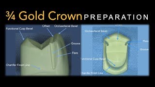 34 Gold Crown Preparation  Maxillary Premolar [upl. by Esirtal293]