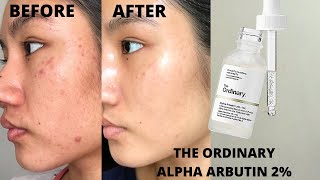 THE ORDINARY ALPHA ARBUTIN 2  HA REVIEW  BEFORE amp AFTER 6 WEEKS [upl. by Hakan60]