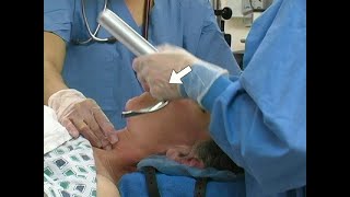 Orotracheal Intubation [upl. by Amitak]