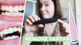 HOW TO REMOVE CALCULUS TARTAR PLAQUE AT HOME  Ultrasonic Tooth Cleaner Review  Does It Work [upl. by Eruot]