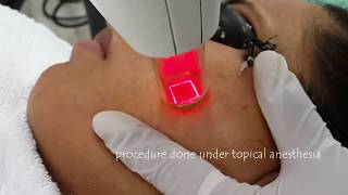 Laser treatment for acne scars  Fractional Non Ablative Laser  Dr Anuj Pall MD PhD FISD USA [upl. by Thane764]