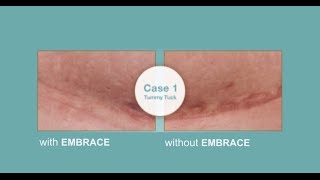 Embrace™ Silicone Tape vs Traditional Scar Treatments [upl. by Ymmac]