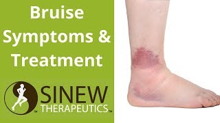 Bruise Symptoms and Treatment [upl. by Hendel]