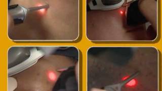 Laser Hair Removal video by Cynosure [upl. by Nedearb692]