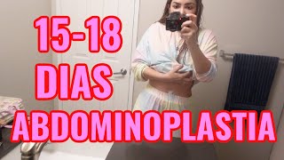 ABDOMINOPLASTIA 15  18 DIAS DESPUES [upl. by Ikilisav]