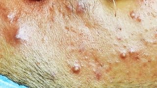 Extraction dacné kystique et pustule  cystic acne [upl. by Enymsaj119]