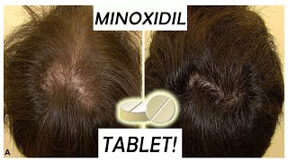 Minoxidil Tablets replacement for 5 MinoxPros amp Cons Episode 1 [upl. by Eissirk]