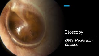 Otitis Media with Effusion Otoscopy [upl. by Ennayt950]