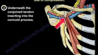 Thoracic Outlet Syndrome  Everything You Need To Know  Dr Nabil Ebraheim [upl. by Refanej]