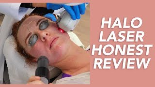 My Halo Laser Experience Honest Review Recovery and Before amp Afters [upl. by Aliber]