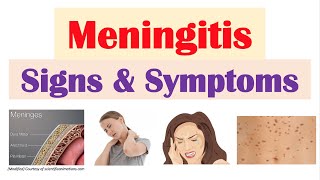 How bacterial meningitis affects the body [upl. by Murton]