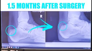 Haglunds Surgery Recovery  15 Months After Surgery [upl. by Alegnaed]