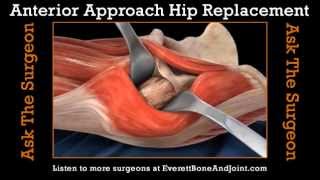 Anterior vs Posterior Hip Replacement Approach [upl. by Laughton789]