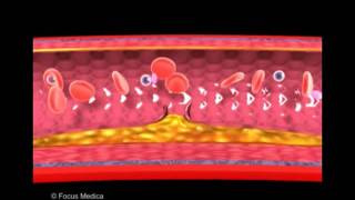 Atherosclerosis and thrombus formation  Heart [upl. by Nayrbo578]