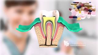 What is a Root Canal Treatment [upl. by Eibbor]