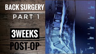 Back Surgery Laminectomy L4L5 Recovery part 1 [upl. by Dnomse]