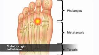 How to kill athletes foot fungus [upl. by Cyna]