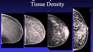 Introduction to Mammography [upl. by Fabrianna]