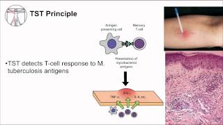 Tuberculosis Diagnosis [upl. by Serilda]