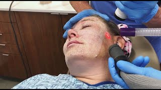 Full Face Fractional CO2 Laser Resurfacing for Wrinkles and Skin Tightening [upl. by Sihtnyc]