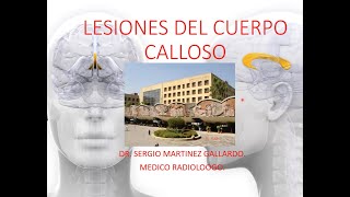 1 2 Lesiones del Cuerpo Calloso  Dr Martínez [upl. by Geirk]