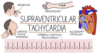 Understanding Supraventricular Tachycardia SVT [upl. by Dunn]