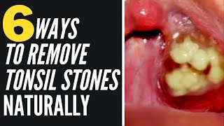 Are Tonsil Stones Dangerous [upl. by Ivetts]